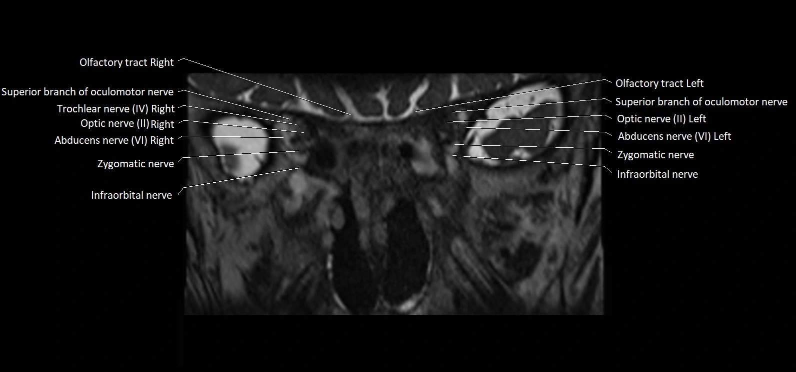 Cranial nerve cross sectional anatomy coronal 3T MRI image 14.webp